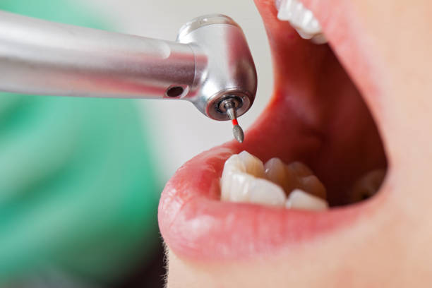 Best Emergency Wisdom Tooth Extraction in Kasson, MN